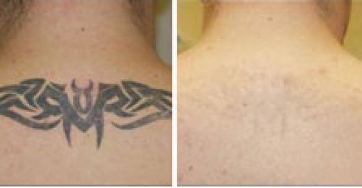 laser-tattoo-removal-8