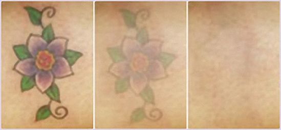 laser-tattoo-removal-pictures-9-1