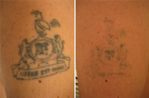 laser-tattoo-removal-tatto-removal_3